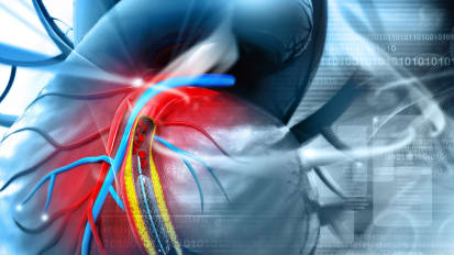 Understanding and Treating Mitral Regurgitation: New Treatment Options