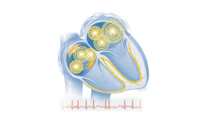 How a year's worth of experience of pulsed field ablation for AFib has revolutionized my practice
