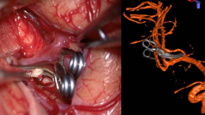 Brain Aneurysms Update | Treatment and Case Reports