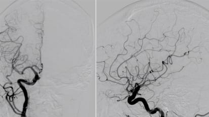 Brain Aneurysms Update | Causes and Risk Factors