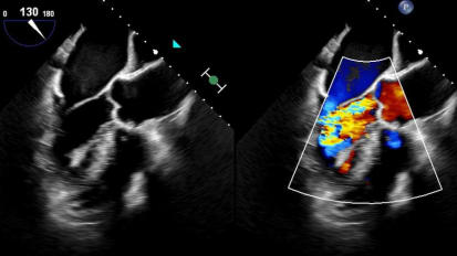 Aortic Insufficiency: Review and Current Therapies