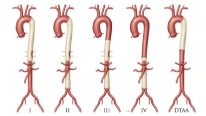 Aortic Surgery: Personalized Medicine with a Team Approach