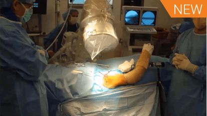 Intramedullary Nails for Proximal Humerus Fractures: When, Why & How? [AP-013754-A]