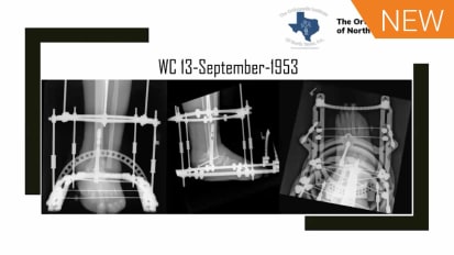 Neuropathic Hindfoot Case Discussion presented by Justin Kane, MD [AP-013887]