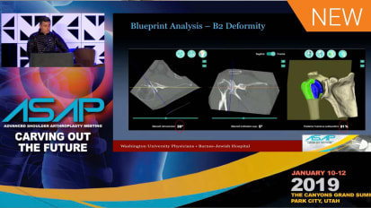 B2: Is Bone Grafting Still an Option? Dr. Keener - ASAP Meeting 2020 [AP-013901]