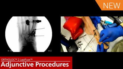 LapiFuse™ Cadaveric Surgery with Drs. W. Hodges Davis and Christopher Hyer [AP-014026]