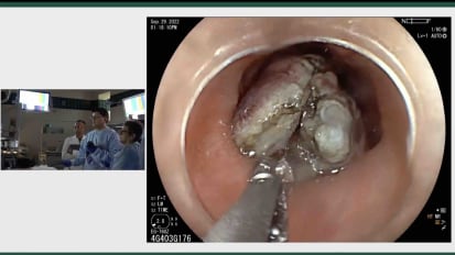 Archbold LIVE! Case 3 - Gastric ESD