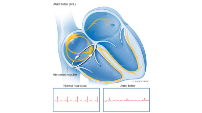 Heart Rhythm Webinar Series: Challenging case discussion with Mayo Clinic experts on atrial flutter