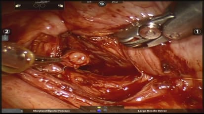 Robotic Repair of Ureterovaginal Fistula using Indocyanine Green and Cosmetic Approach