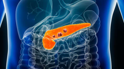 Watch Now! Innovations in the Management of Pancreatic Cancer