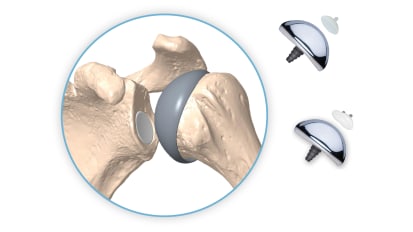 Paradigm Shift in Total Shoulder Arthroplasty