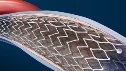 Optimize Venous Stenting Outcomes