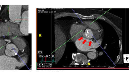 Bicuspid Aortic Valve Disease