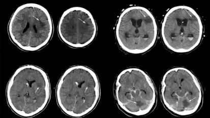 Inside the Black Box - Brain Multimodality Monitoring