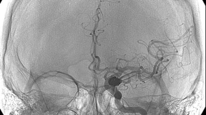 Spontaneous Intracerebral Hemorrhage