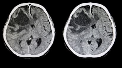 Brain Tumors (for the Non-Neurosurgeon)