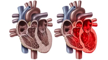 Stress Induced Cardiomyopathy