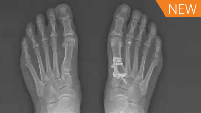 LapiFuse™: Finding a Better Way to Bunion Correction Case Review with Dr. Jeremy McCormick [AP-013825A]