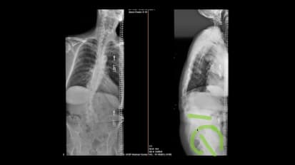 Approach to the Older Patient with Spinal Disorders: Diagnosis