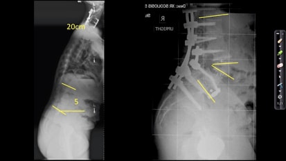 Approach to the Older Patient with Spinal Disorders: Surgery