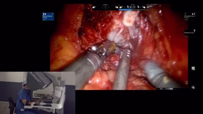 Live Robotic Prostatectomy Surgery - Archive