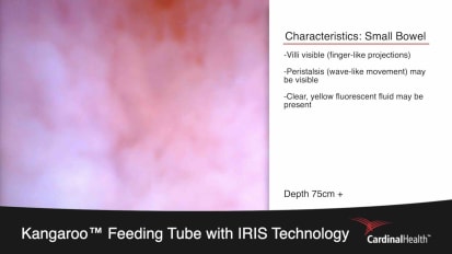 Narrated Placement C: Kangaroo™ Feeding Tube with IRIS Technology