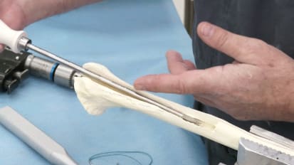 Humeral Osteotomy Technique [CAW-9273]