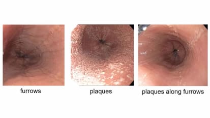 Eosinophilic Esophagitis