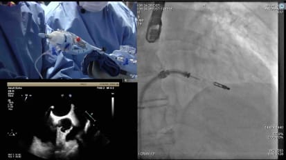 Dr. Sharma and colleagues present a live mitral valve repair procedure
