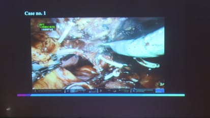 Optimizing Robotic Partial Nephrectomy Outcomes by Ketan K. Badani, MD