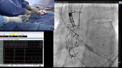 Dr. Sharma performs a TAVR procedure