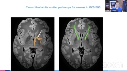 Towards Personalized Connectomic DBS for OCD