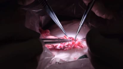 Mount Sinai Surgeons Perform First Human Tracheal Transplant Surgery