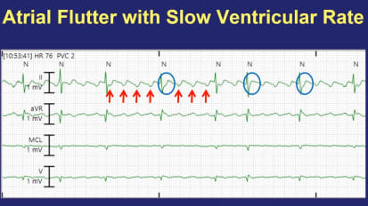 Telemetry Tips Part 1: Atrial Flutter and Atrial Tachycardia