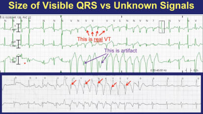 Telemetry Tips Part 3: Electrical Artifacts