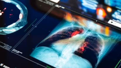 Lung Cancer Screening and SPN in the Patient with COP