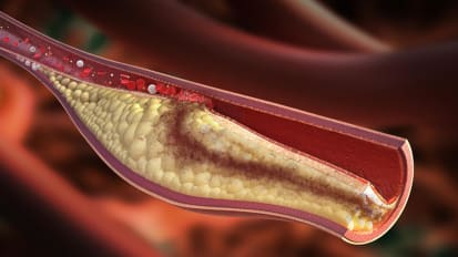 Is coronary plaque regression possible?