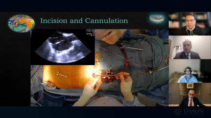 Let's Talk Contemporary Surgery for Primary Mitral Regurgitation