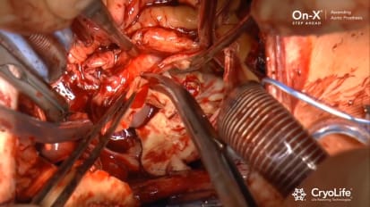 On-X AAP Implant Video