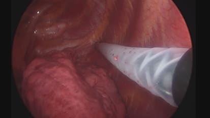 Intercostal nerve cryotherapy