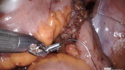 Day 1: Robot-Assisted Radical Cystoprostatectomy with Bilateral Lymph Node Dissection<br>Part 3: Neobladder ICUD