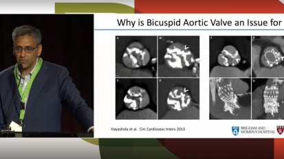 TAVR低风险病人对SAVR低风险病人