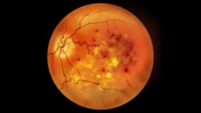 Novel glucose-lowering medications and impact on diabetic retinopathy