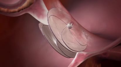 Should you close a PFO with a small shunt and no atrial septal aneurysm?
