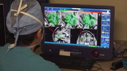 MRI-Guided Surgical Ablation for Brain Tumors