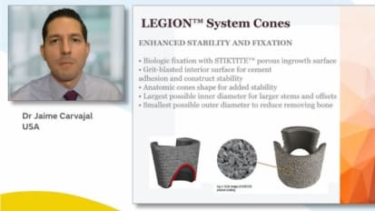 Planning a Revision TKA Using LEGION™ RK System