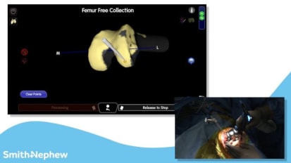 Surgical Overview of the Revision Knee Workflow with the CORI™ Surgical System