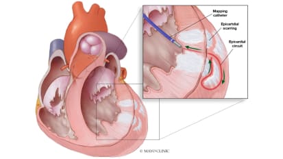 Heart Rhythm Webinar Series: Challenging case discussion with Mayo Clinic experts on mapping difficult rhythms