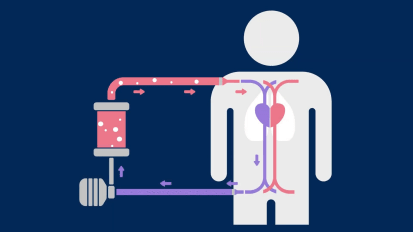 ECMO: A 2- Minute Overview