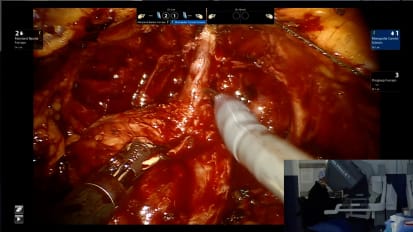 Live Robotic Prostatectomy Surgery